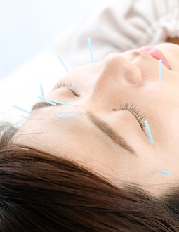 エイジングケア美容鍼