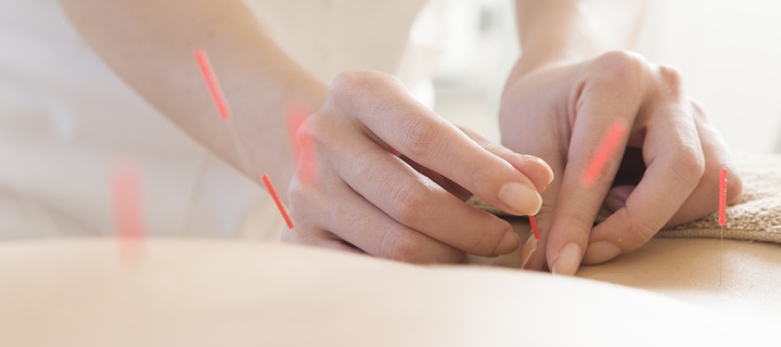 4.トリガーポイント鍼